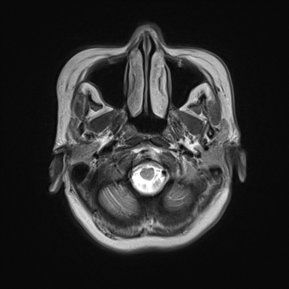File:Clival meningioma (Radiopaedia 53278-59248 Axial T2 1).jpg