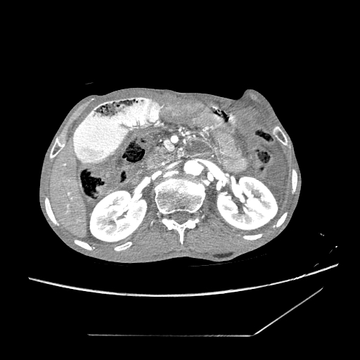 Closed-loop obstruction due to peritoneal seeding mimicking internal hernia after total gastrectomy (Radiopaedia 81897-95864 A 52).jpg