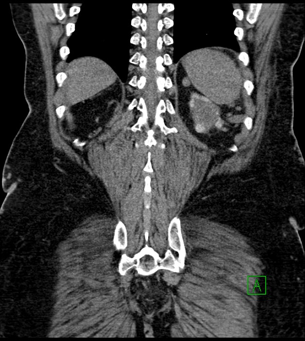 Closed-loop small bowel obstruction-internal hernia (Radiopaedia 78439-91096 Coronal non-contrast 83).jpg