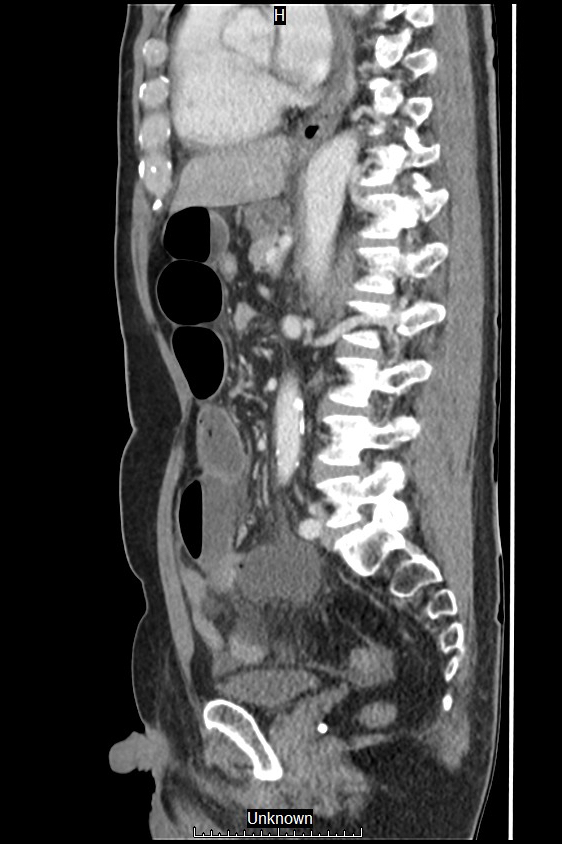 Closed loop bowel obstruction and ischemia (Radiopaedia 86959-103180 C 27).jpg