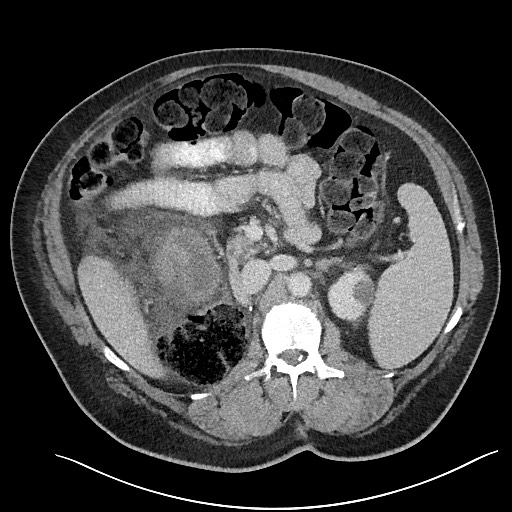 File:Closed loop obstruction - internal hernia into nephrectomy bed (Radiopaedia 59867-67320 A 51).jpg