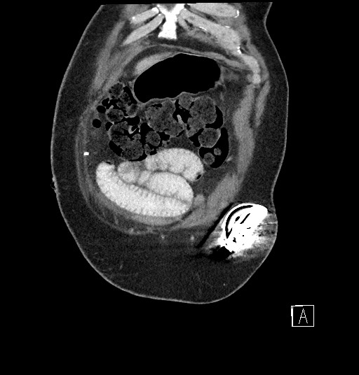 File:Closed loop obstruction - internal hernia into nephrectomy bed (Radiopaedia 59867-67320 B 7).jpg