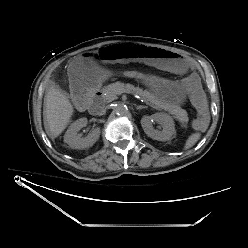 Closed loop obstruction due to adhesive band, resulting in small bowel ischemia and resection (Radiopaedia 83835-99023 Axial non-contrast 56).jpg