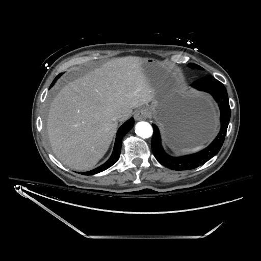 File:Closed loop obstruction due to adhesive band, resulting in small bowel ischemia and resection (Radiopaedia 83835-99023 B 28).jpg