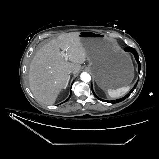 File:Closed loop obstruction due to adhesive band, resulting in small bowel ischemia and resection (Radiopaedia 83835-99023 B 33).jpg