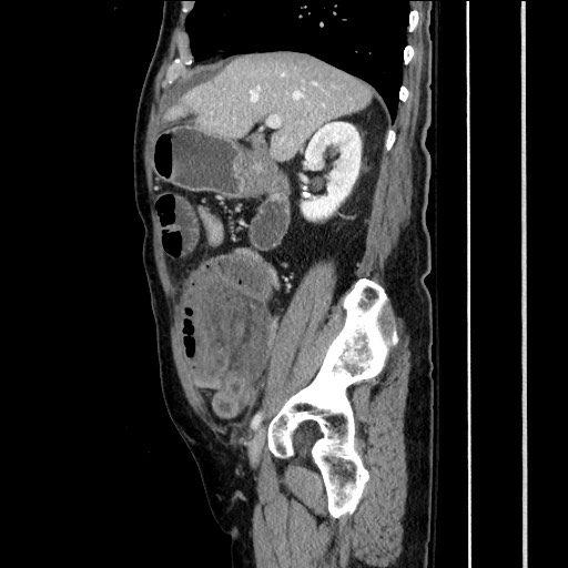 File:Closed loop obstruction due to adhesive band, resulting in small bowel ischemia and resection (Radiopaedia 83835-99023 F 67).jpg