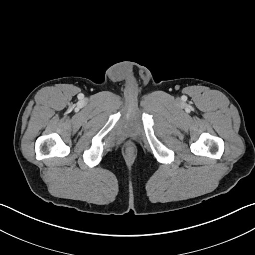 Closed loop small bowel obstruction - internal hernia (Radiopaedia 57806-64778 B 140).jpg
