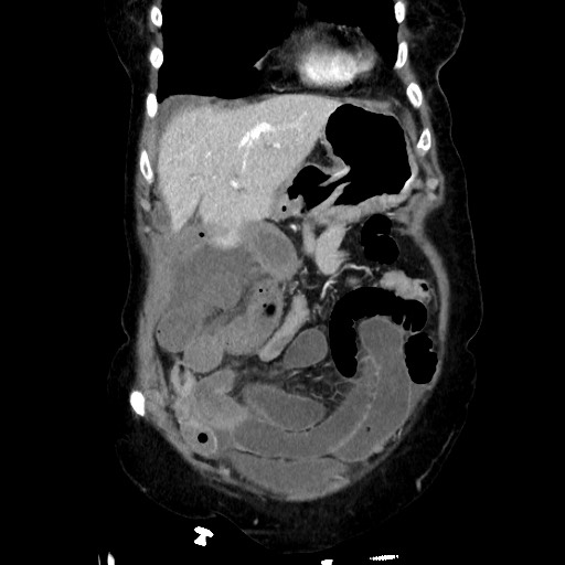 Closed loop small bowel obstruction due to adhesive band, with intramural hemorrhage and ischemia (Radiopaedia 83831-99017 C 34).jpg