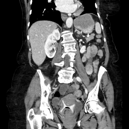 Closed loop small bowel obstruction due to adhesive band, with intramural hemorrhage and ischemia (Radiopaedia 83831-99017 C 75).jpg