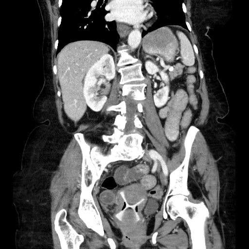 Closed loop small bowel obstruction due to adhesive band, with intramural hemorrhage and ischemia (Radiopaedia 83831-99017 C 78).jpg