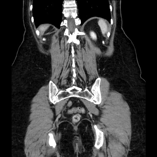 Closed loop small bowel obstruction due to adhesive bands - early and late images (Radiopaedia 83830-99014 B 101).jpg
