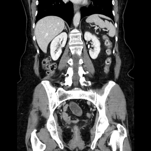 Closed loop small bowel obstruction due to adhesive bands - early and late images (Radiopaedia 83830-99015 B 82).jpg