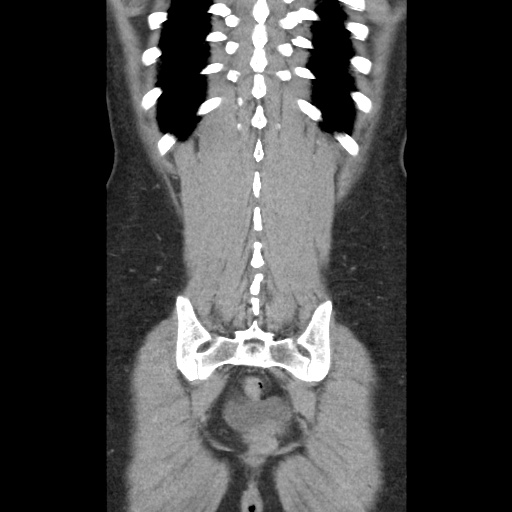 File:Closed loop small bowel obstruction due to trans-omental herniation (Radiopaedia 35593-37109 B 45).jpg