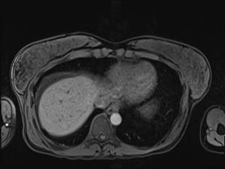 Closed loop small bowel obstruction in pregnancy (MRI) (Radiopaedia 87637-104031 Axial T1 fat sat 12).jpg
