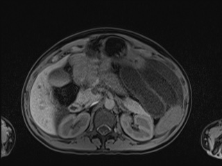 Closed loop small bowel obstruction in pregnancy (MRI) (Radiopaedia 87637-104031 Axial T1 fat sat 41).jpg