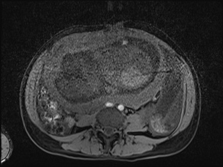 Closed loop small bowel obstruction in pregnancy (MRI) (Radiopaedia 87637-104031 F 14).jpg