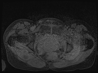Closed loop small bowel obstruction in pregnancy (MRI) (Radiopaedia 87637-104031 F 72).jpg