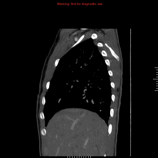 File:Coarctation of the aorta (Radiopaedia 9434-10118 B 3).jpg
