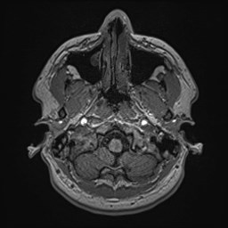 File:Cochlear incomplete partition type III associated with hypothalamic hamartoma (Radiopaedia 88756-105498 Axial T1 36).jpg