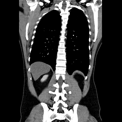 File:Codominant double aortic arch (Radiopaedia 56012-62637 B 35).jpg