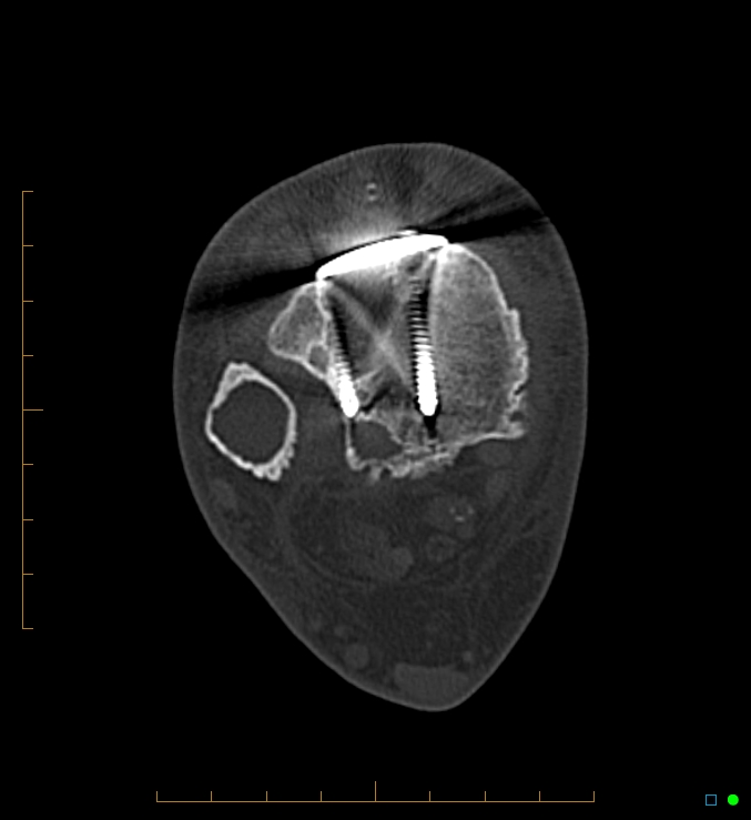 Collapsed total ankle replacement (Radiopaedia 17228-16932 Axial bone window 6).jpg