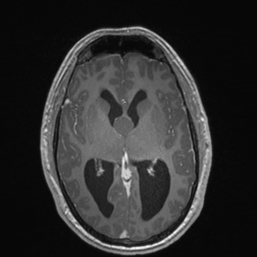 File:Colloid cyst (Radiopaedia 44510-48181 Axial T1 C+ 93).png