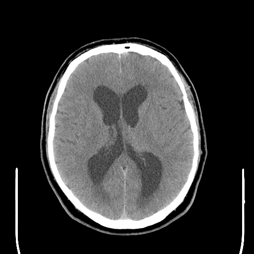 File:Colloid cyst (large) (Radiopaedia 34415-35734 Axial non-contrast 32).png