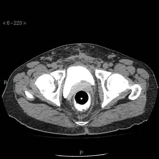 File:Colo-cutaneous fistula (Radiopaedia 40531-43129 A 93).jpg