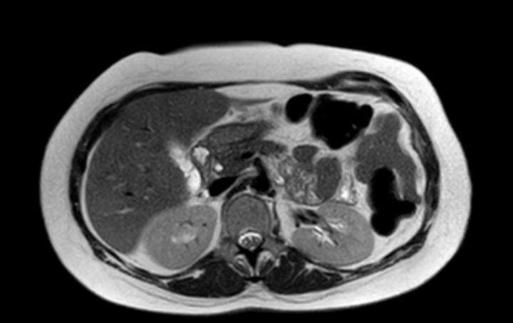 Colon adenocarcinoma with Krukenberg tumors, advanced pregnancy (Radiopaedia 67279-76645 Axial T2 58).jpg