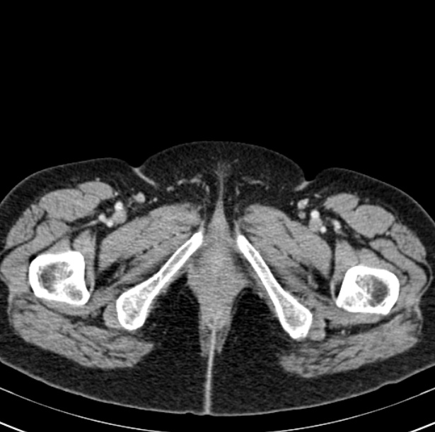 Colon carcinoma with hepatic metastases (Radiopaedia 29477-29961 A 125).jpg