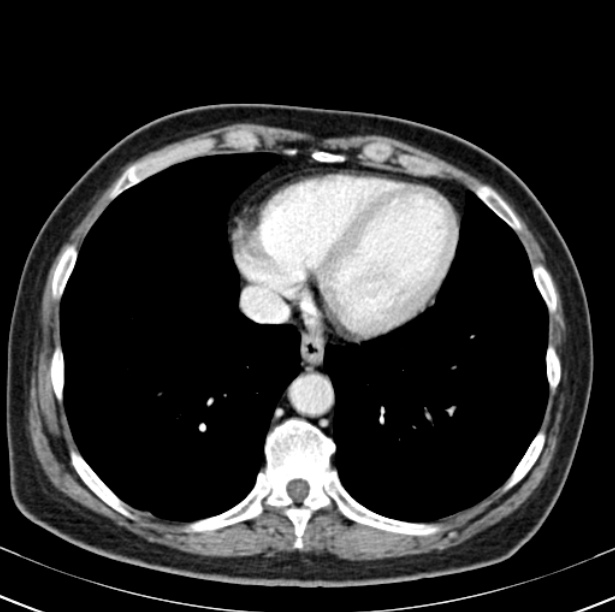 Colon carcinoma with hepatic metastases (Radiopaedia 29477-29961 A 5).jpg