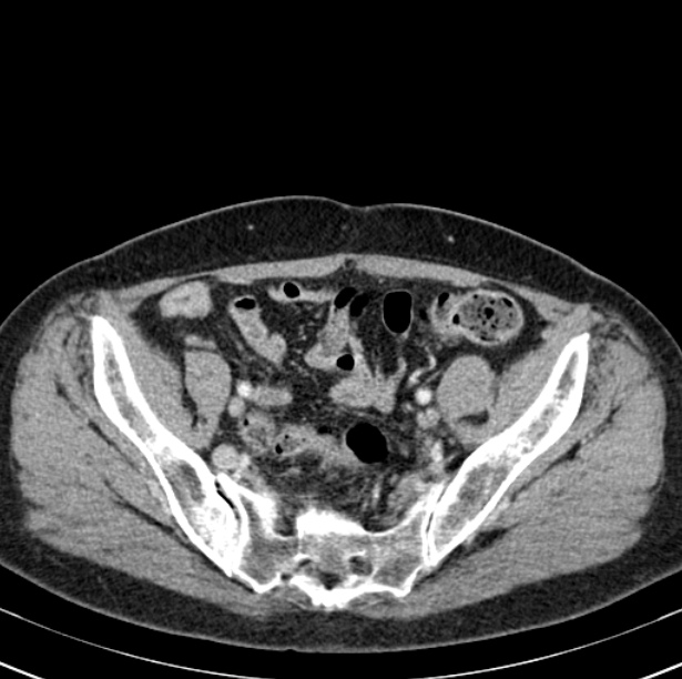 Colon carcinoma with hepatic metastases (Radiopaedia 29477-29961 A 92).jpg