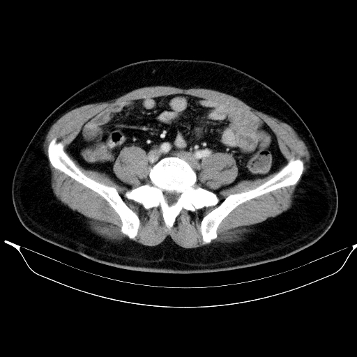 Colonic lipoma with colo-colic intussusception (Radiopaedia 58944-66200 A 46).jpg