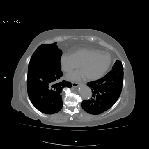 File:Colonic lipomas (Radiopaedia 49137-54244 Axial bone window 15).jpg