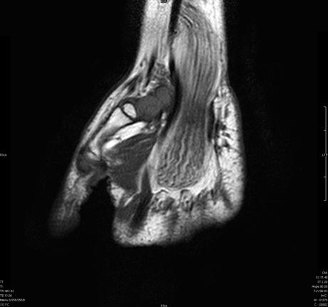 File:Fibrolipomatous hamartoma of median nerve (Radiopaedia 7825).jpg