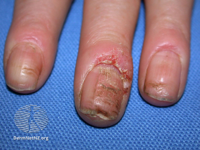 File:Hand dermatitis (DermNet NZ dermatitis-hand-dermatitis-2840).jpg