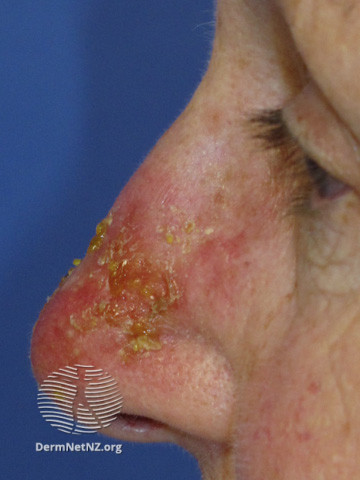File:How ingenol mebutate works on actinic keratoses are incompletely understood. It appears to have a dual mechanism of action- (DermNet NZ treatments-ingenol-1day2).jpg