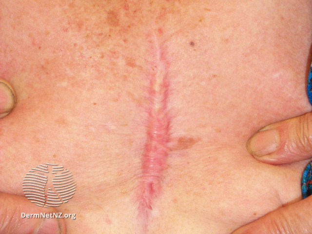 File:Hypertrophic scar (DermNet NZ dermal-infiltrative-hypertrophic-scar4).jpg