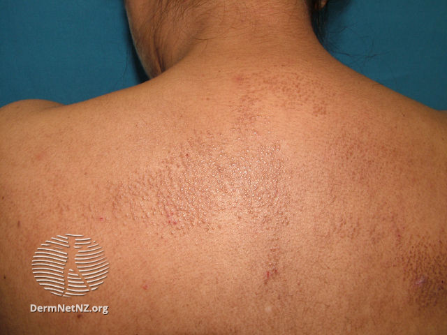 File:Lichen amyloidosis (DermNet NZ amyloid1ajpg).jpg