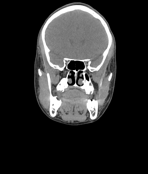 Nasal pyogenic granuloma (lobular capillary hemangioma) (Radiopaedia 85536-101244 Coronal non-contrast 96).jpg