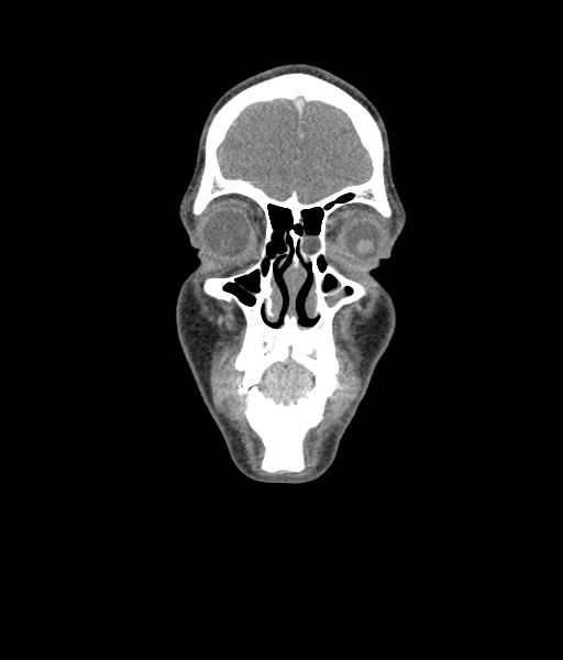 Nasal pyogenic granuloma (lobular capillary hemangioma) (Radiopaedia 85536-101244 D 49).jpg