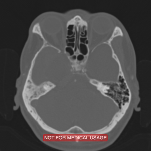 Nasopharyngeal carcinoma recurrence - skull base destruction (Radiopaedia 29107-29490 Axial bone window 77).jpg
