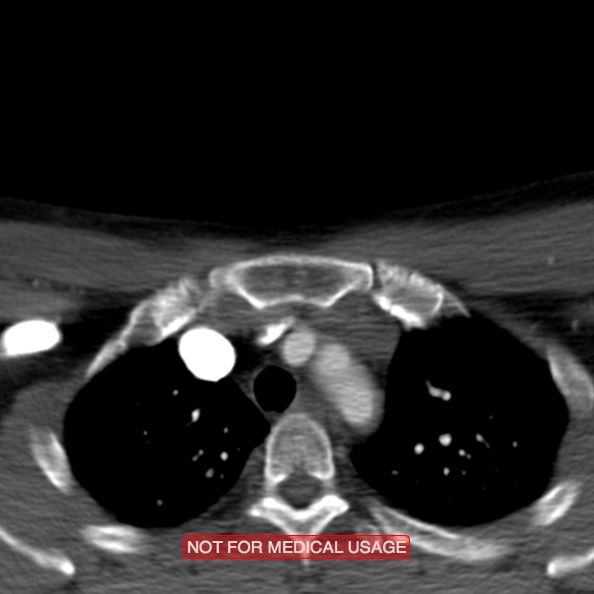 File:Nasopharyngeal carcinoma recurrence - skull base destruction (Radiopaedia 29107-29491 A 41).jpg
