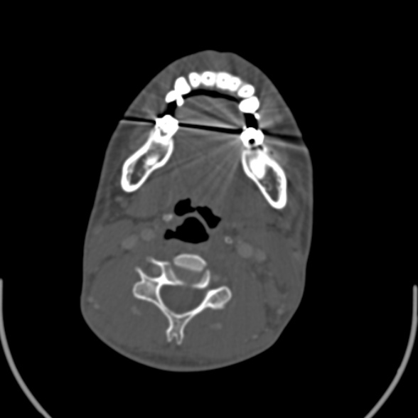 Nasopharyngeal carcinoma with skull base invasion (Radiopaedia 53415-59705 Axial bone window 116).jpg