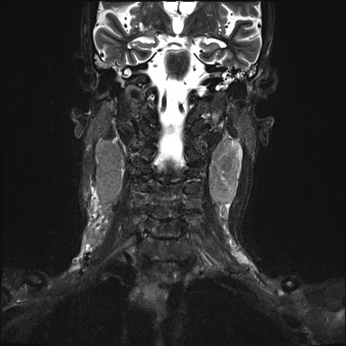 Nasopharyngeal carcinoma with skull base invasion (Radiopaedia 59258-66600 Coronal T2 fat sat 11).jpg