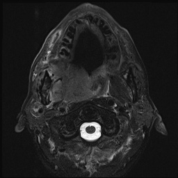 File:Nasopharyngeal carcinoma with skull base invasion (Radiopaedia 59258-66600 D 27).jpg