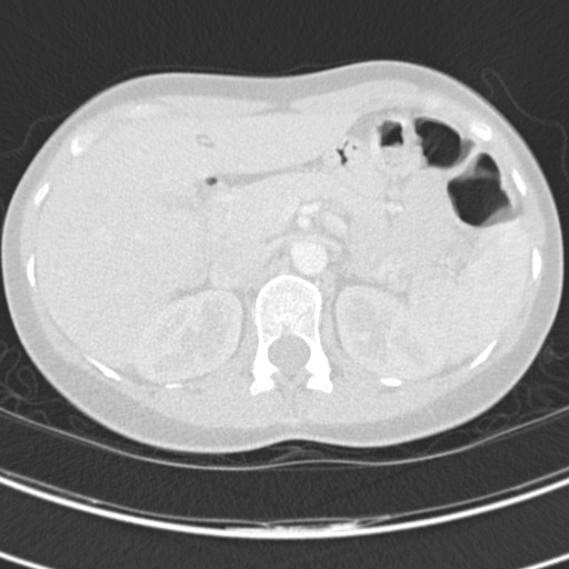 Necrobiotic pulmonary nodules - Crohn disease (Radiopaedia 20723-20631 Axial lung window 148).jpg
