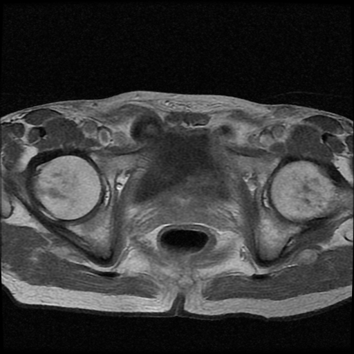 File:Necrotizing epididymo-orchitis with intra-testicular abscess (Radiopaedia 29397-29860 Axial T1 C+ 3).jpg