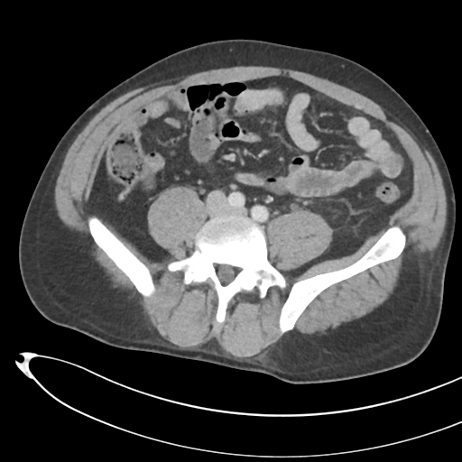 File:Necrotizing pancreatitis with acute necrotic collections (Radiopaedia 38829-41012 B 54).png