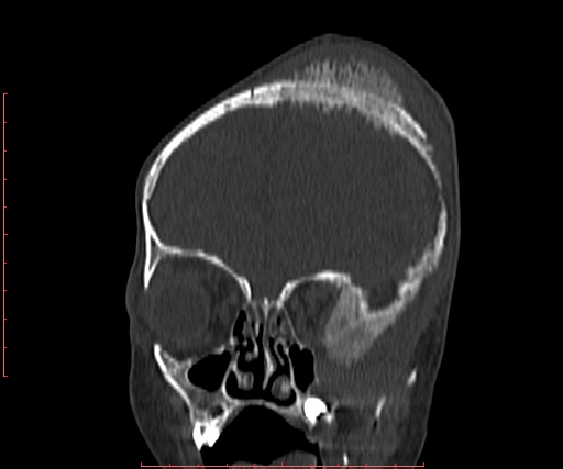 File:Neuroblastoma skull metastasis (Radiopaedia 56053-62683 Coronal bone window 10).jpg